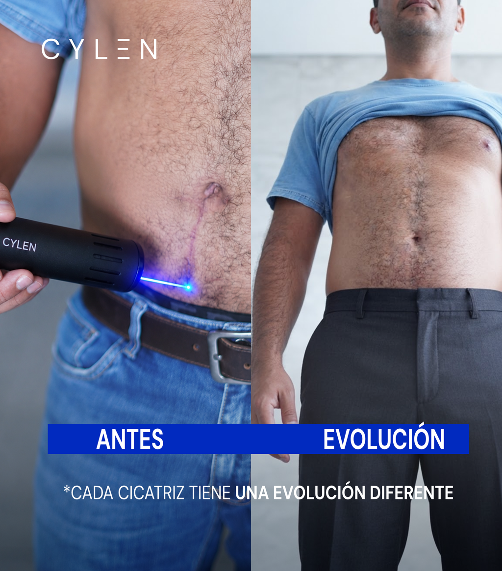 CYLEN Cicatriz